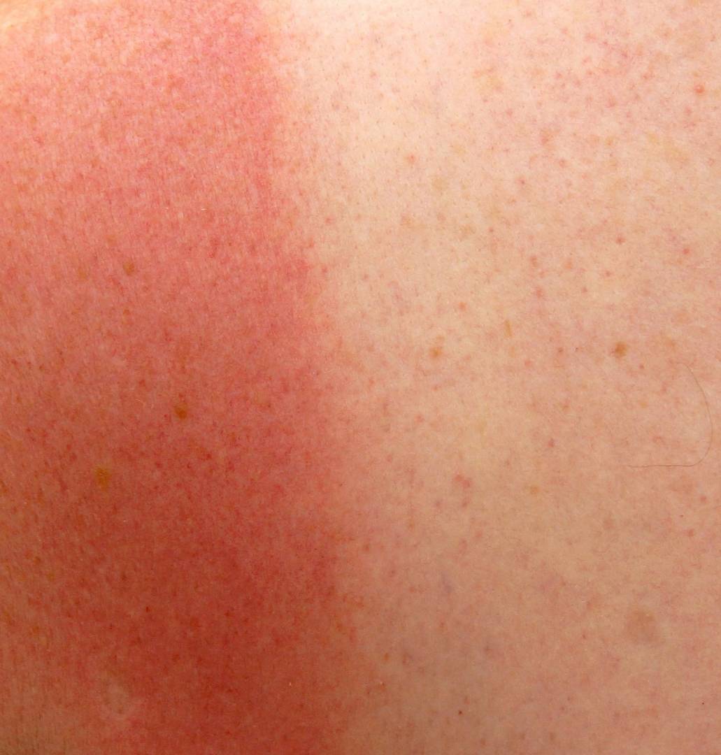les UV pur soigner la dermatite atopique