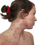 ECLA : étude sur la dermatite atopique de l'adulte