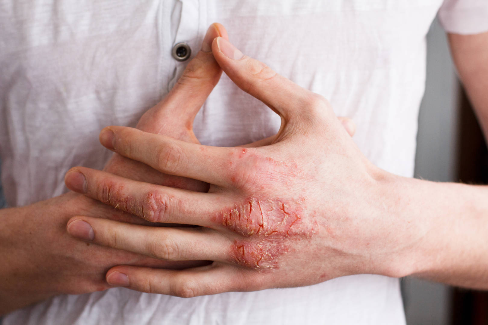 eczéma et lavage des mains