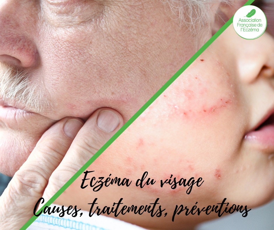 Eczéma du visage, quelles causes ? - Association Française de l'eczéma