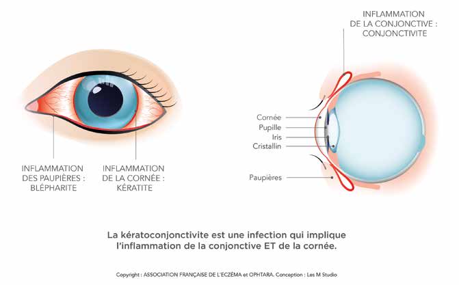 keratoconjonctivite de l'enfant