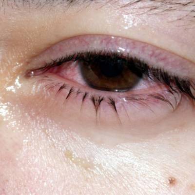 conjonctivite eczema yeux