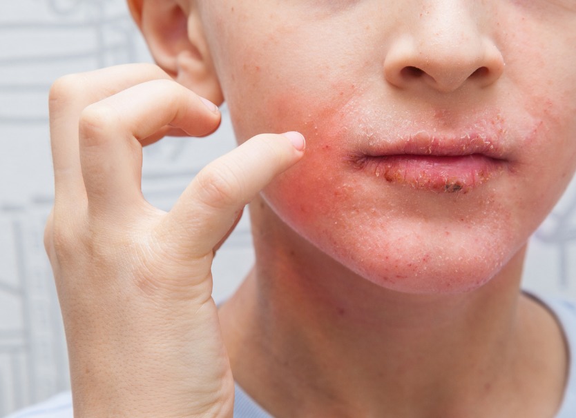 eczema de la bouche