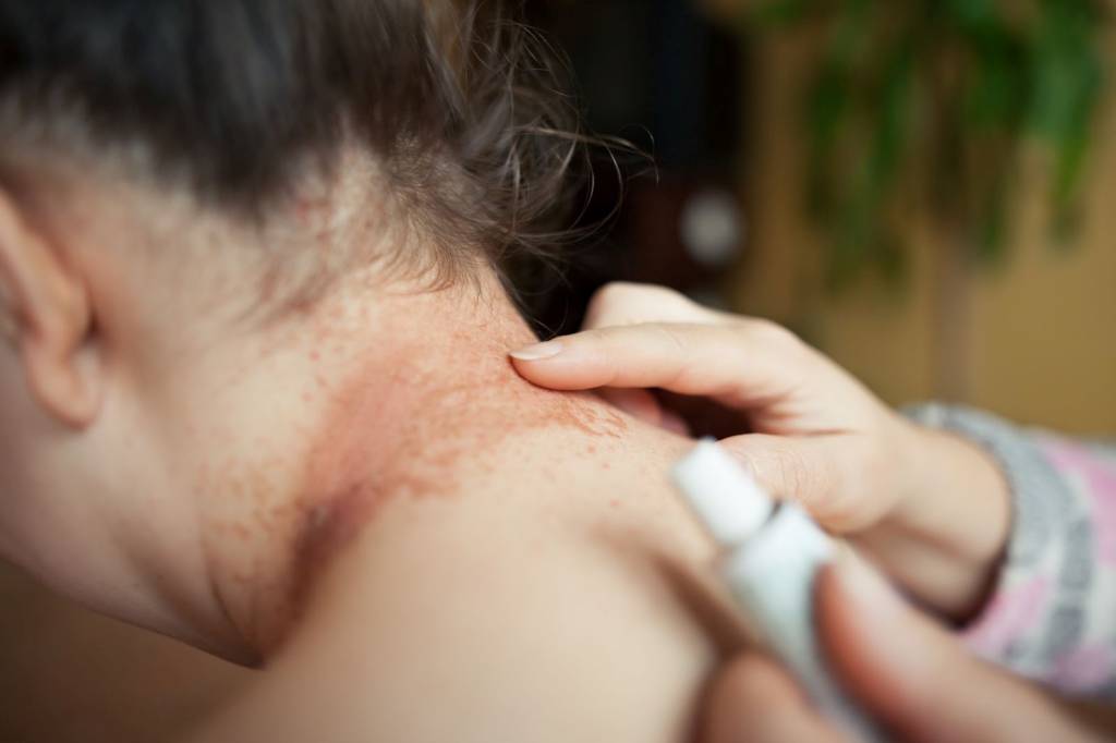 eczéma laisse des cicatrices