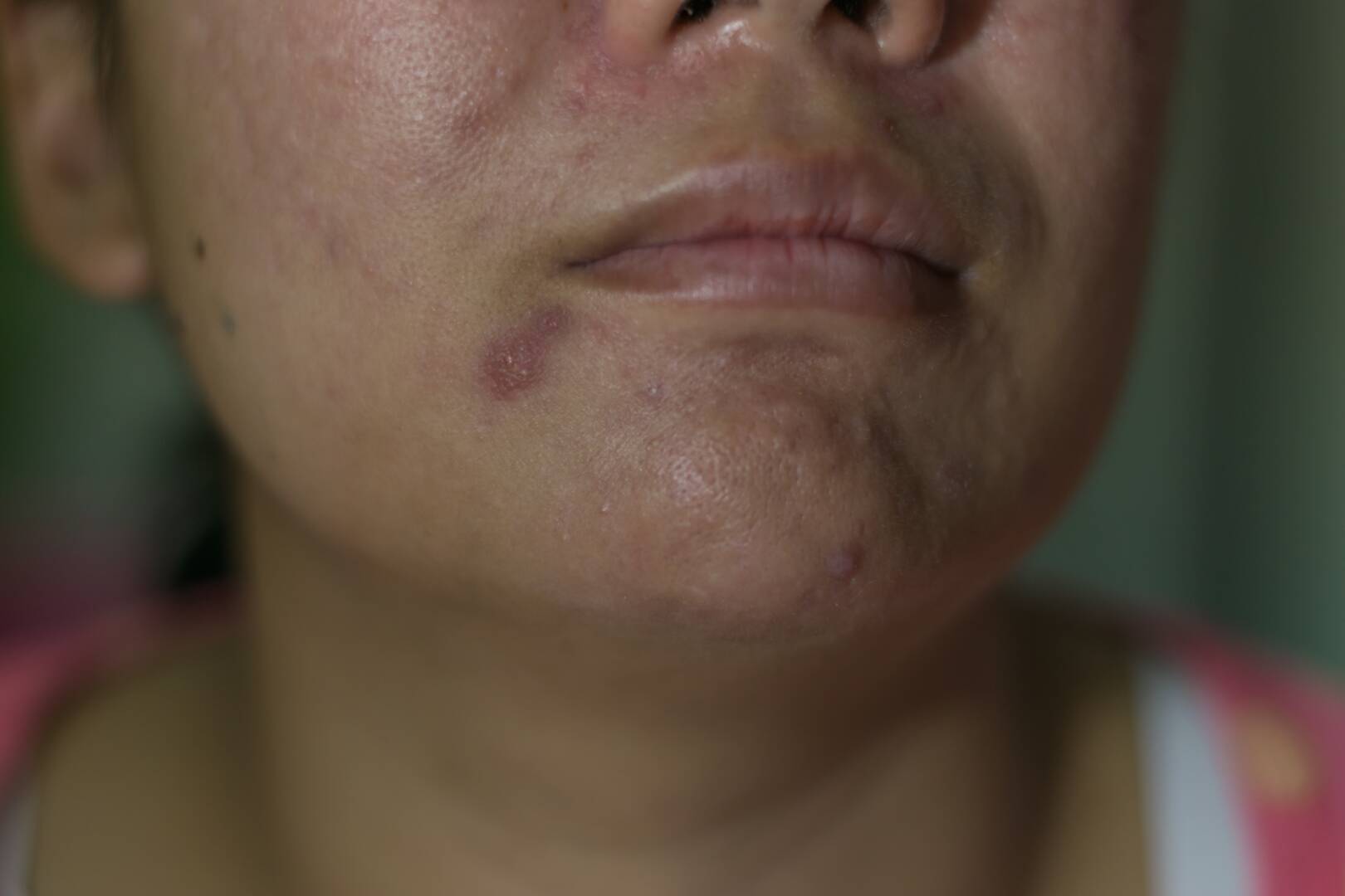 dermatite atopique infection cutanée