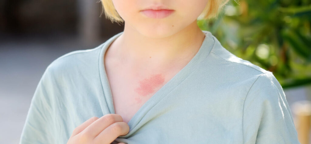 Un enfant avec de l'eczéma